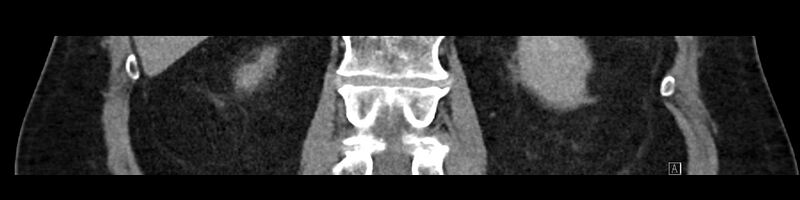 File:Buried bumper syndrome - gastrostomy tube (Radiopaedia 63843-72575 Coronal Inject 73).jpg