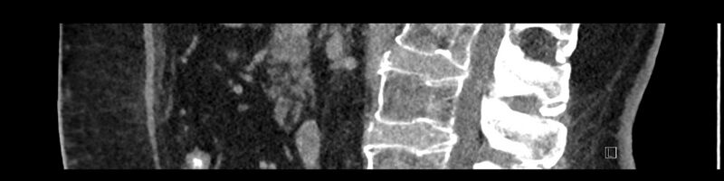 File:Buried bumper syndrome - gastrostomy tube (Radiopaedia 63843-72575 Sagittal Inject 65).jpg