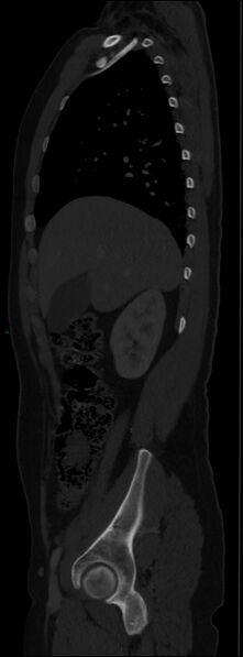 File:Burst fracture (Radiopaedia 83168-97542 Sagittal bone window 46).jpg