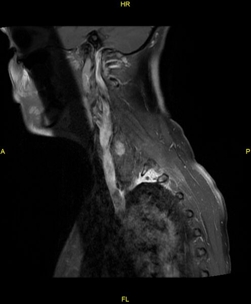 File:C5 nerve sheath tumor (Radiopaedia 85777-101596 F 17).jpg