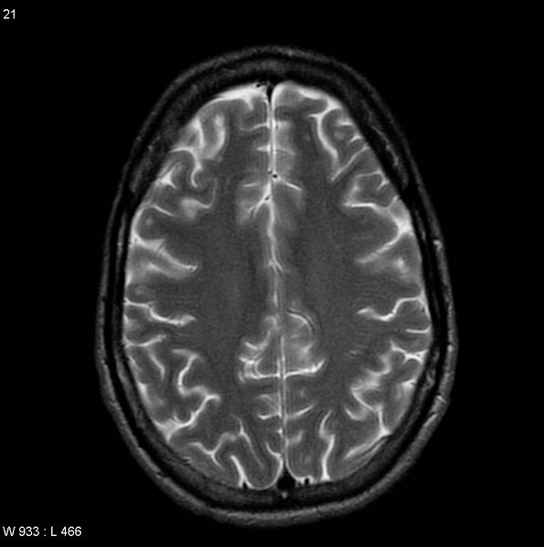 File:CMV ventriculitis and encephalitis (Radiopaedia 5416-7166 T2 6).jpg