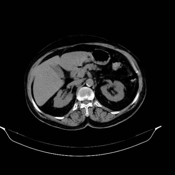 File:Calcified hydatid cyst (Radiopaedia 62000-70085 Axial non-contrast 39).jpg