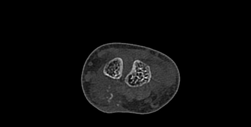 File:Calcifying aponeurotic fibroma (Radiopaedia 88423-105064 Axial bone window 54).jpg