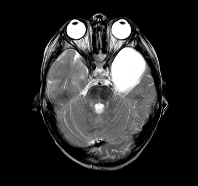 File:Callosal dysgenesis and ectopic posterior pituitary (Radiopaedia 8382-9213 Axial T2 12).jpg