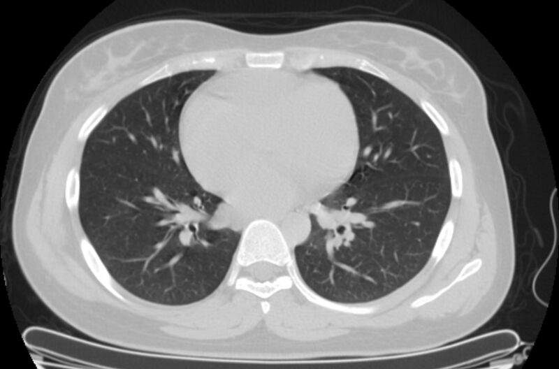 File:Cannonball metastases - uterine choriocarcinoma (Radiopaedia 70137-80173 Axial lung window 62).jpg