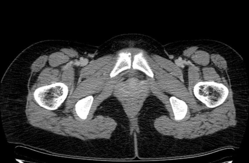 Cannonball metastases - uterine choriocarcinoma (Radiopaedia 70137-80174 A 67).jpg