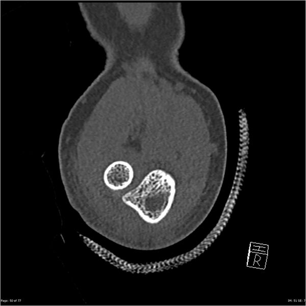 File:Capitellum fracture (Radiopaedia 23352-23426 Coronal bone window 50).jpg