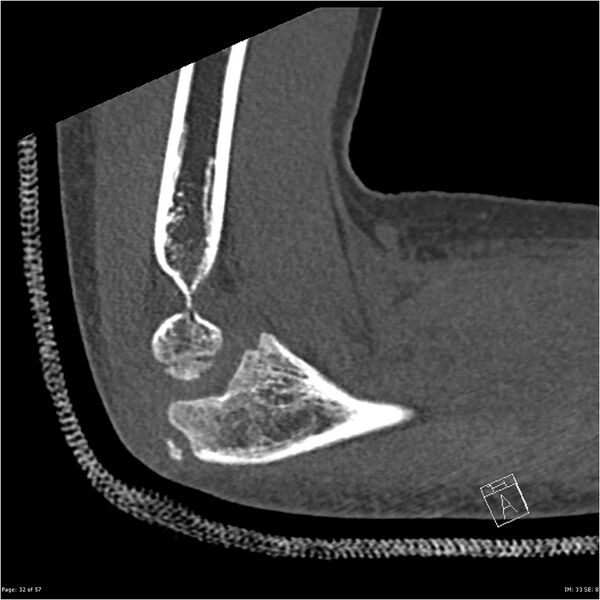 File:Capitellum fracture (Radiopaedia 23352-23426 Sagittal bone window 32).jpg