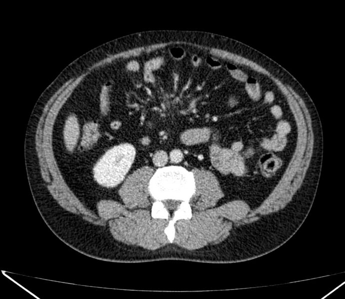File:Carcinoid tumor with hepatic metastases (Radiopaedia 22651-22670 C 54).jpg