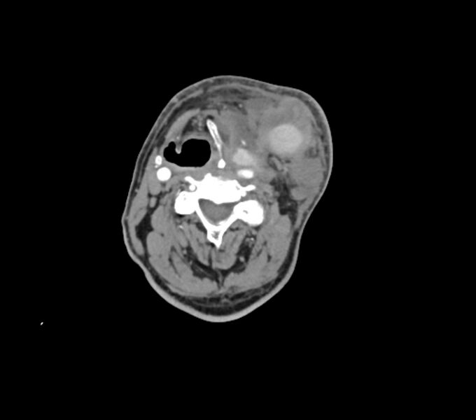 File:Carotid artery pseudoaneurysm (Radiopaedia 84030-99259 C 41).jpg