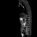 Caudal regression syndrome (Radiopaedia 61990-70072 Sagittal T2 TIRM 1).jpg