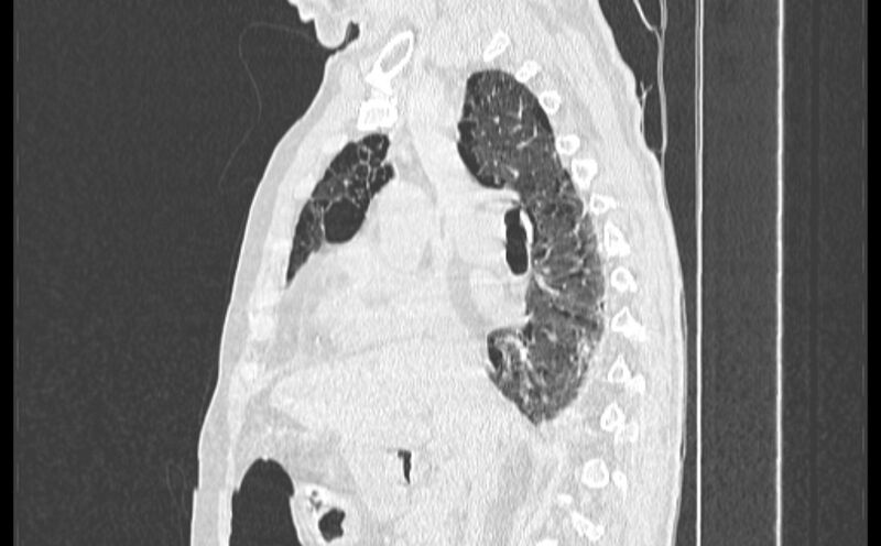 File:Cavitating bronchogenic carcinoma (Radiopaedia 44489-48162 Sagittal lung window 23).jpg