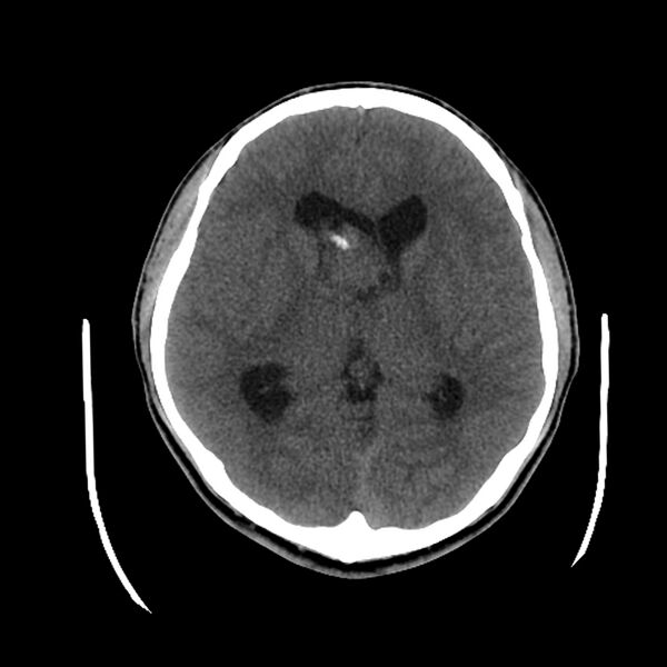 File:Central neurocytoma (Radiopaedia 79320-92379 Axial non-contrast 26).jpg