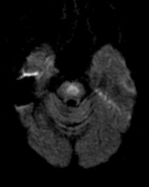 File:Central pontine myelinolysis (Radiopaedia 2598-6296 Axial DWI 1).jpg