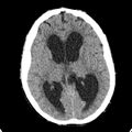 Cerebellar abscess secondary to mastoiditis (Radiopaedia 26284-26412 Axial non-contrast 82).jpg