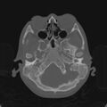 Cerebellar abscess secondary to mastoiditis (Radiopaedia 26284-26413 Axial bone window 34).jpg