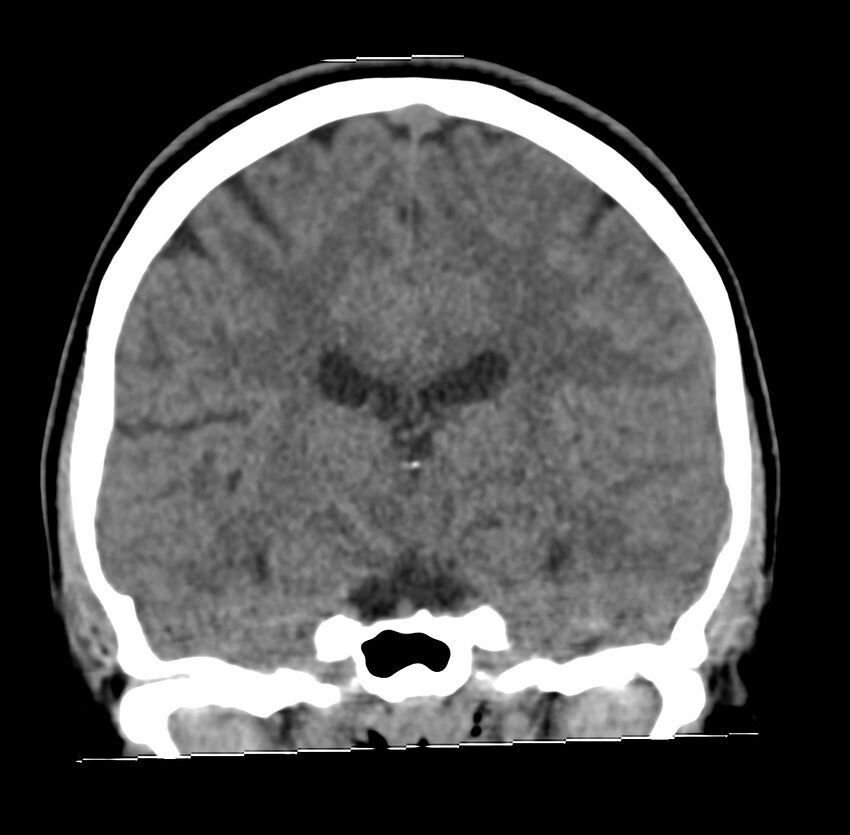 Cerebellar agenesis (Radiopaedia 30203-30817 Coronal non-contrast 21).jpg