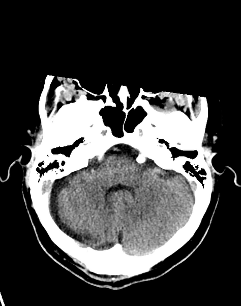File:Cerebellar infarct due to vertebral artery dissection with posterior fossa decompression (Radiopaedia 82779-97033 Axial non-contrast 10).png