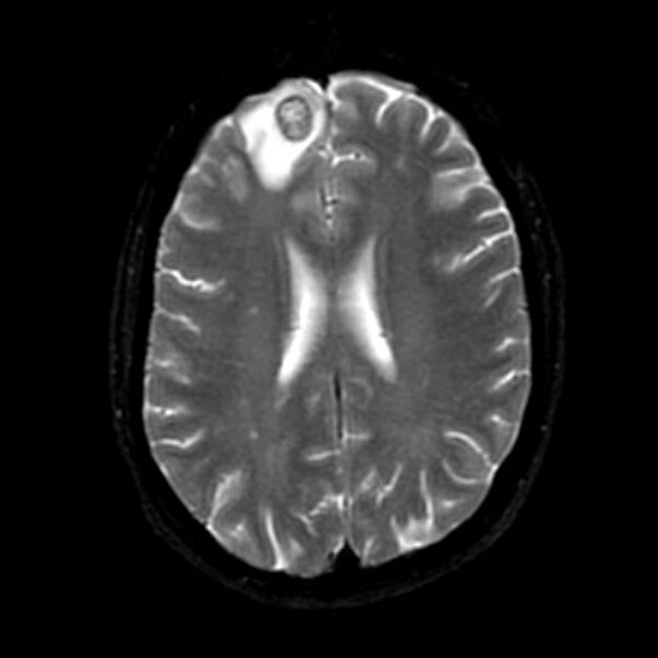 File:Cerebral abscess (Radiopaedia 9975-10538 Axial T2 1).jpg
