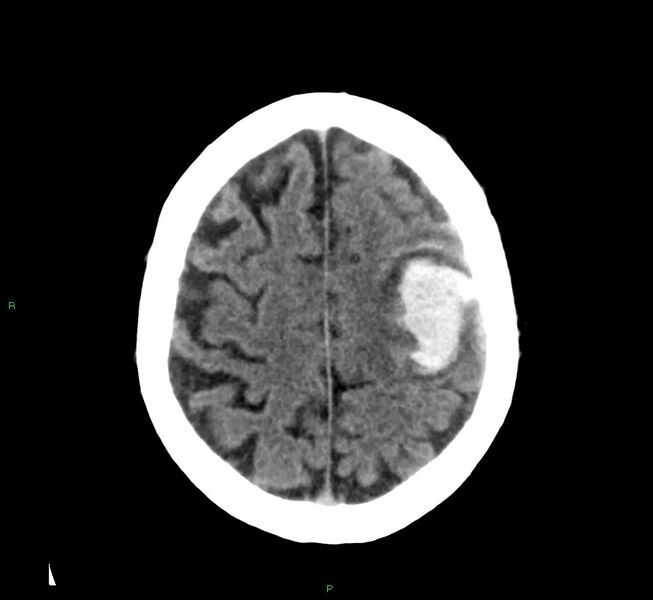 File:Cerebral amyloid angiopathy-associated lobar intracerebral hemorrhage (Radiopaedia 58376-65511 Axial non-contrast 16).jpg