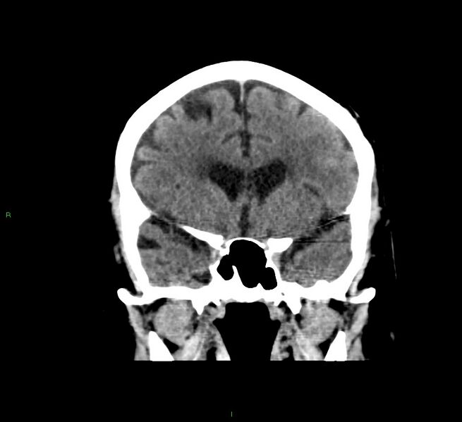 File:Cerebral amyloid angiopathy-associated lobar intracerebral hemorrhage (Radiopaedia 58376-65511 Coronal non-contrast 43).jpg