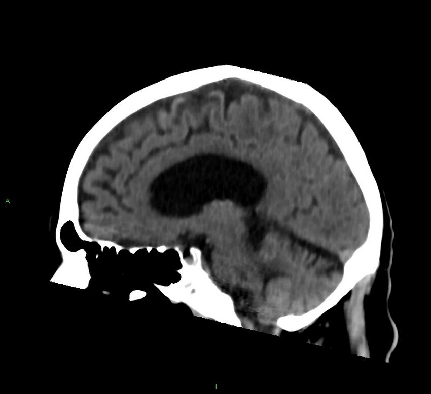 Cerebral amyloid angiopathy-associated lobar intracerebral hemorrhage (Radiopaedia 58376-65513 C 35).jpg