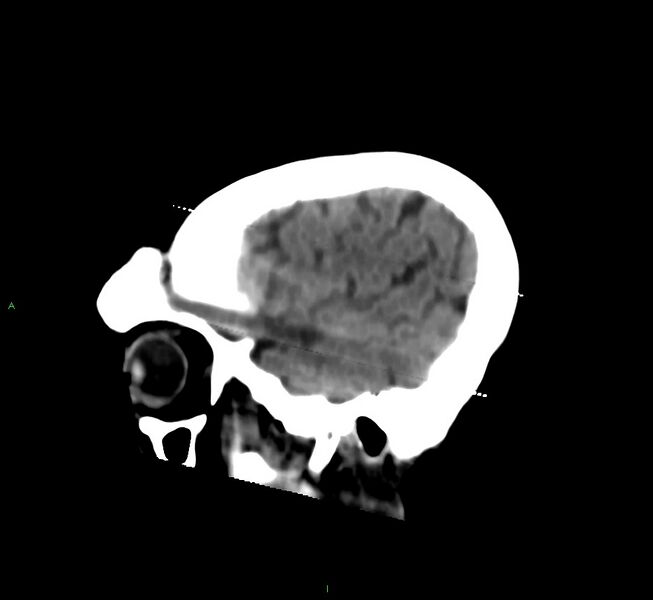 File:Cerebral amyloid angiopathy-associated lobar intracerebral hemorrhage (Radiopaedia 58377-65514 B 43).jpg