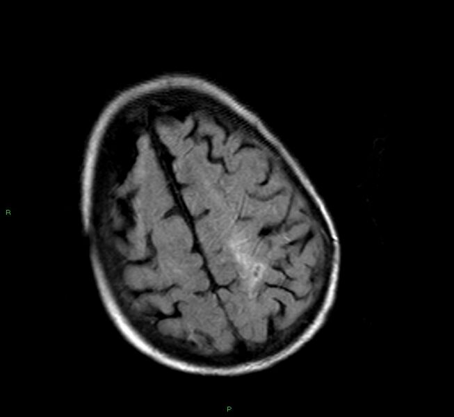 File:Cerebral amyloid angiopathy-associated lobar intracerebral hemorrhage (Radiopaedia 58377-65515 Axial FLAIR 7).jpg