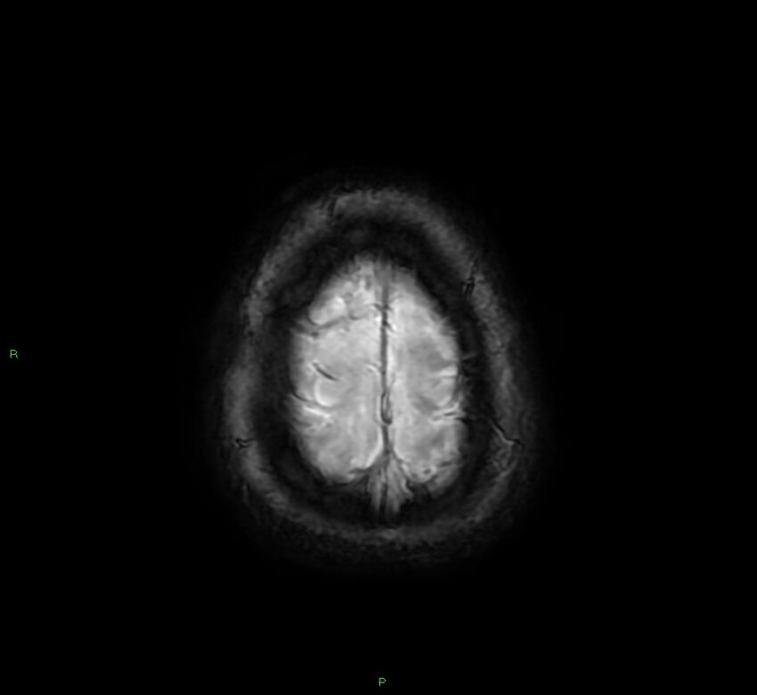 Cerebral amyloid angiopathy-associated lobar intracerebral hemorrhage (Radiopaedia 58378-65517 Axial SWI 68).jpg