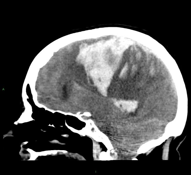 File:Cerebral amyloid angiopathy-associated lobar intracerebral hemorrhage (Radiopaedia 58379-65519 C 25).jpg
