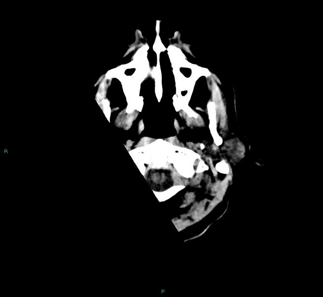 File:Cerebral amyloid angiopathy-associated lobar intracerebral hemorrhage (Radiopaedia 58529-65681 Axial non-contrast 52).jpg