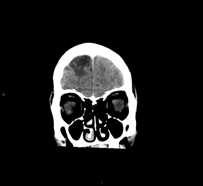 File:Cerebral amyloid angiopathy-associated lobar intracerebral hemorrhage (Radiopaedia 58529-65681 Coronal non-contrast 55).jpg