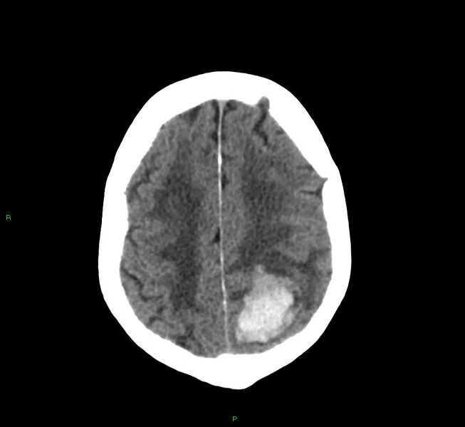 File:Cerebral amyloid angiopathy-associated lobar intracerebral hemorrhage (Radiopaedia 58530-65688 Axial non-contrast 12).jpg