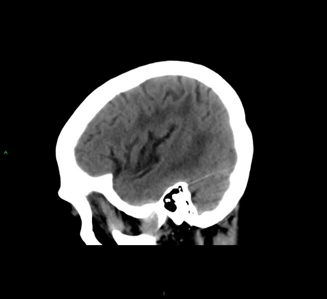 File:Cerebral amyloid angiopathy-associated lobar intracerebral hemorrhage (Radiopaedia 58561-65724 C 11).jpg