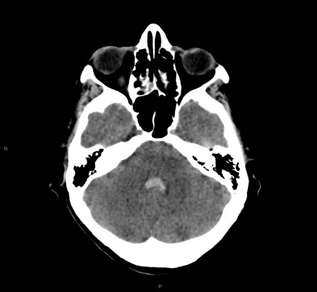 File:Cerebral amyloid angiopathy-associated lobar intracerebral hemorrhage (Radiopaedia 58566-65730 Axial non-contrast 38).jpg