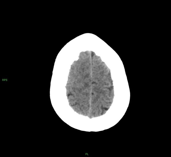 File:Cerebral amyloid angiopathy-associated lobar intracerebral hemorrhage (Radiopaedia 58569-65734 Axial non-contrast 15).jpg