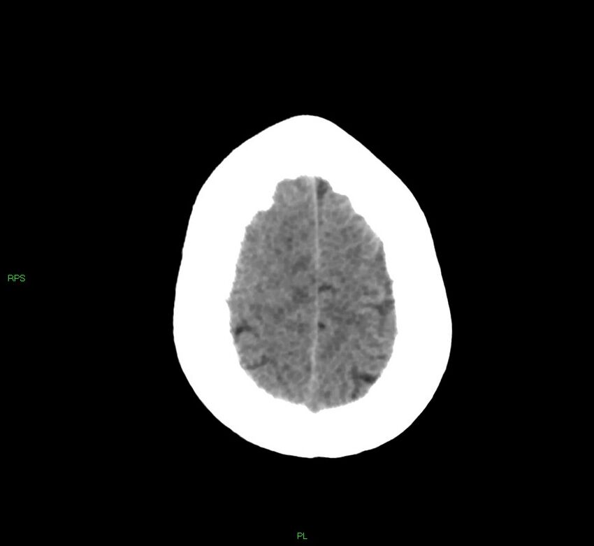 Cerebral amyloid angiopathy-associated lobar intracerebral hemorrhage (Radiopaedia 58569-65734 Axial non-contrast 15).jpg