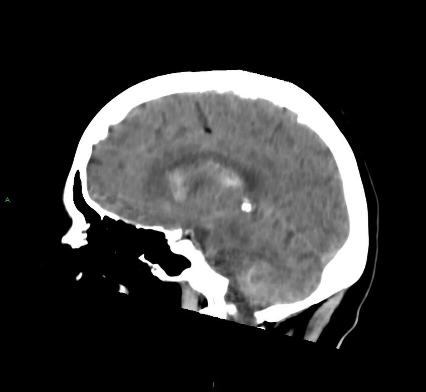 Cerebral amyloid angiopathy-associated lobar intracerebral hemorrhage (Radiopaedia 58752-65973 C 25).jpg