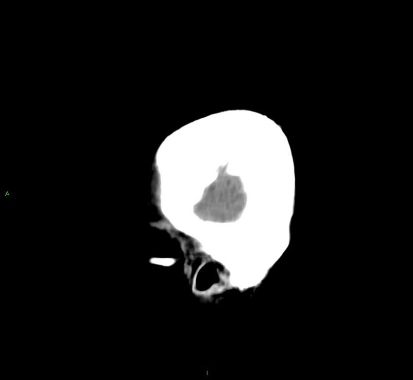 Cerebral amyloid angiopathy-associated lobar intracerebral hemorrhage (Radiopaedia 58752-65973 C 7).jpg