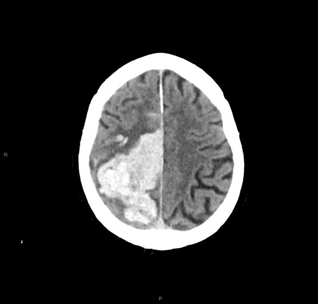 File:Cerebral amyloid angiopathy-associated lobar intracerebral hemorrhage (Radiopaedia 59356-66716 Axial non-contrast 12).jpg