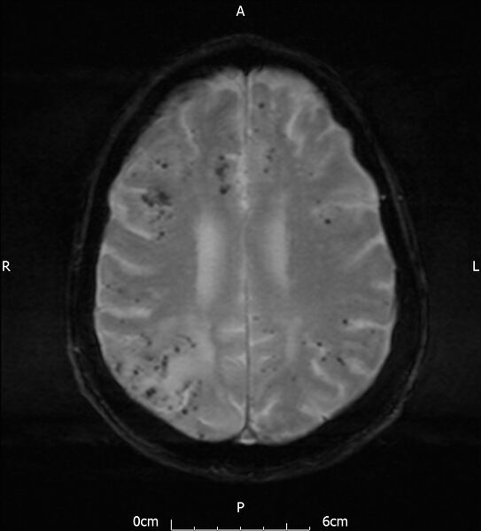File:Cerebral amyloid angiopathy related inflammation (Radiopaedia 72772-83415 Axial SWI 16).jpg