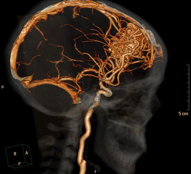 File:Cerebral arteriovenous malformation (Radiopaedia 29531-30031 C 3).jpg