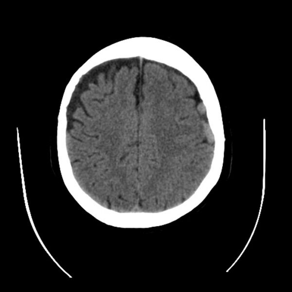 File:Cerebral arteriovenous malformation (Radiopaedia 43729-47189 Axial non-contrast 31).jpg