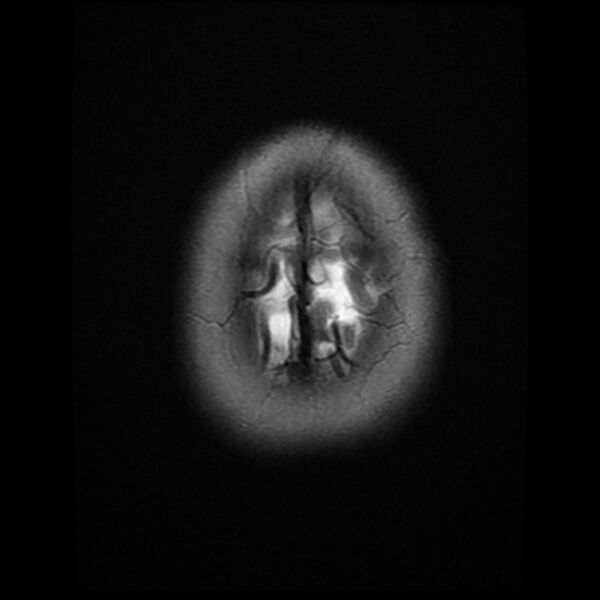 File:Cerebral cavernous malformation (Radiopaedia 44301-47942 Axial T2 20).jpg