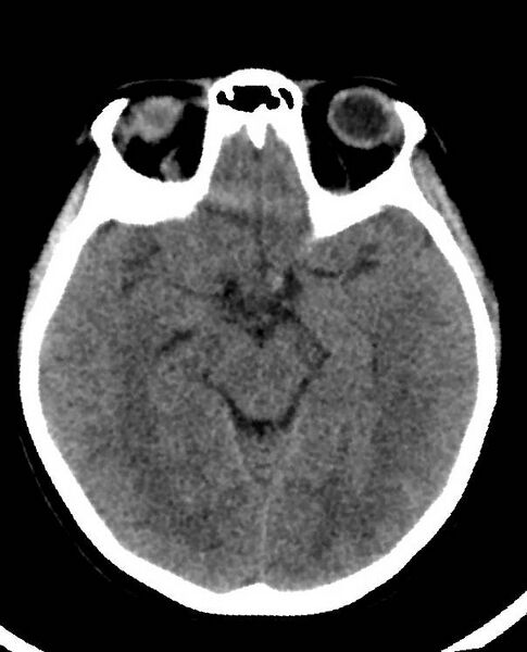 File:Cerebral edema due to severe hyponatremia (Radiopaedia 89826-106938 Axial non-contrast 44).jpg