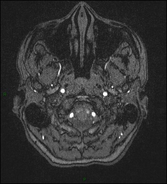 File:Cerebral fat embolism (Radiopaedia 35022-36525 Axial TOF 1).jpg