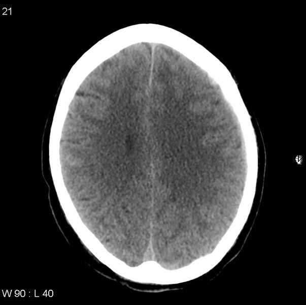 File:Cerebral hemorrhagic contusion with subdural and subarachnoid hemorrhage (Radiopaedia 10680-11146 Axial non-contrast 18).jpg