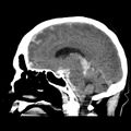 Cerebral hemorrhagic contusions (Radiopaedia 23145-23188 C 24).jpg
