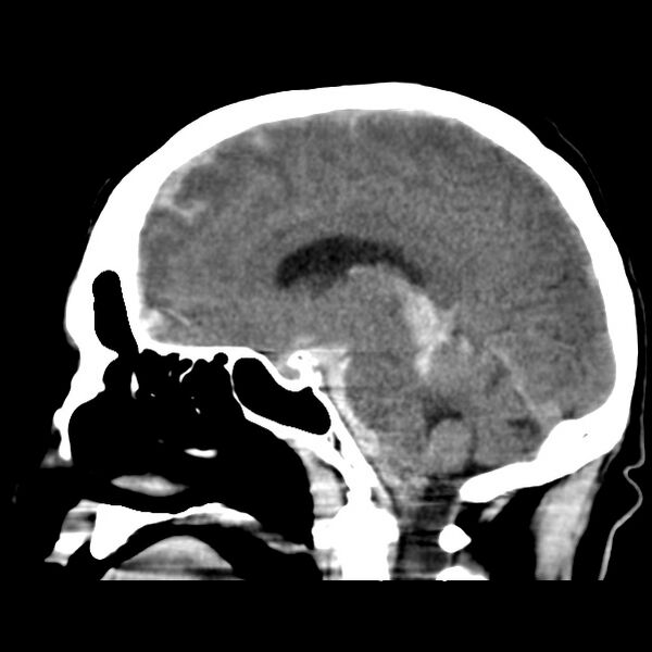 File:Cerebral hemorrhagic contusions (Radiopaedia 23145-23188 C 24).jpg