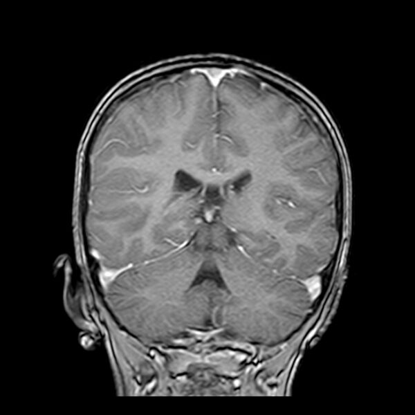 File:Cerebral tuberculoma (Radiopaedia 41152-43932 Coronal T1 C+ 13).jpg